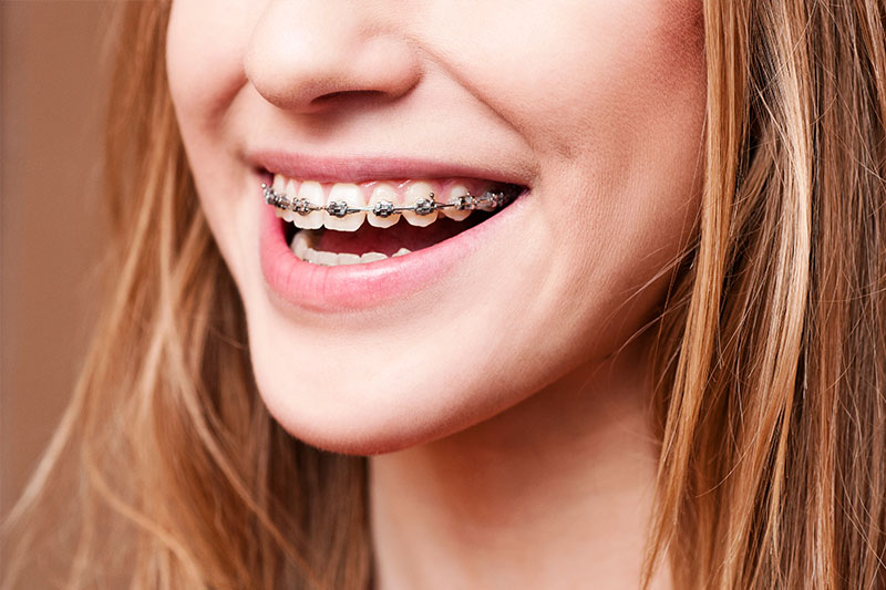 Orthodontics in Schaumburg