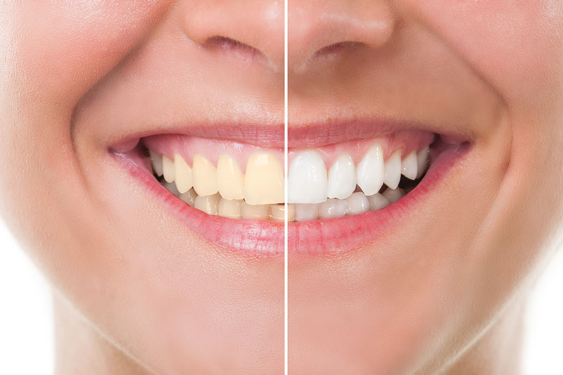 Teeth Whitening in Schaumburg